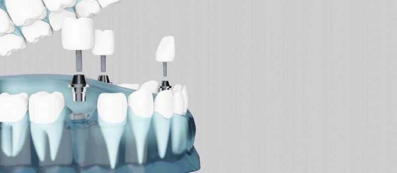 A model of dental implants.