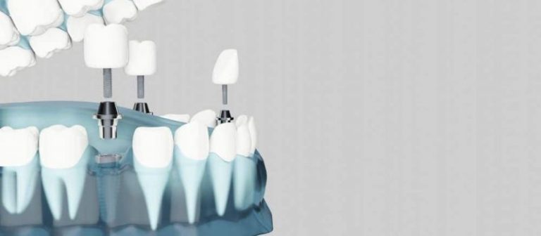 A model of dental implants.